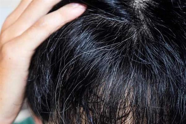 Stress, improper sleep, junk food main reasons for premature hair greying:  Doctors